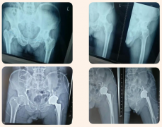 【醫(yī)訊】臨滄市中醫(yī)醫(yī)院骨科成功開展全髖關(guān)節(jié)置換術(shù)